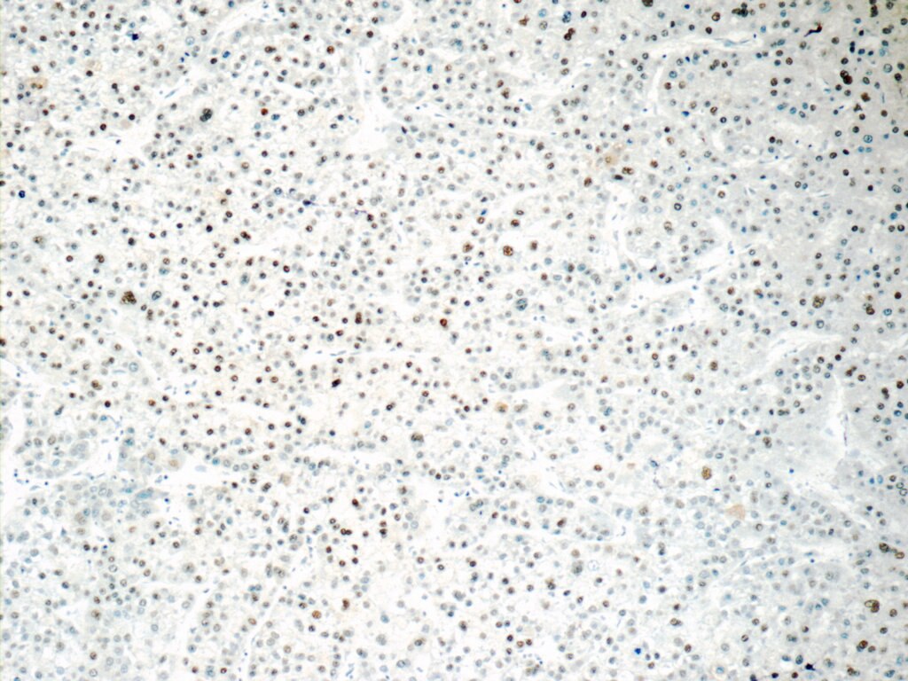 Immunohistochemistry (IHC) staining of human liver cancer tissue using ONECUT1 Polyclonal antibody (25137-1-AP)