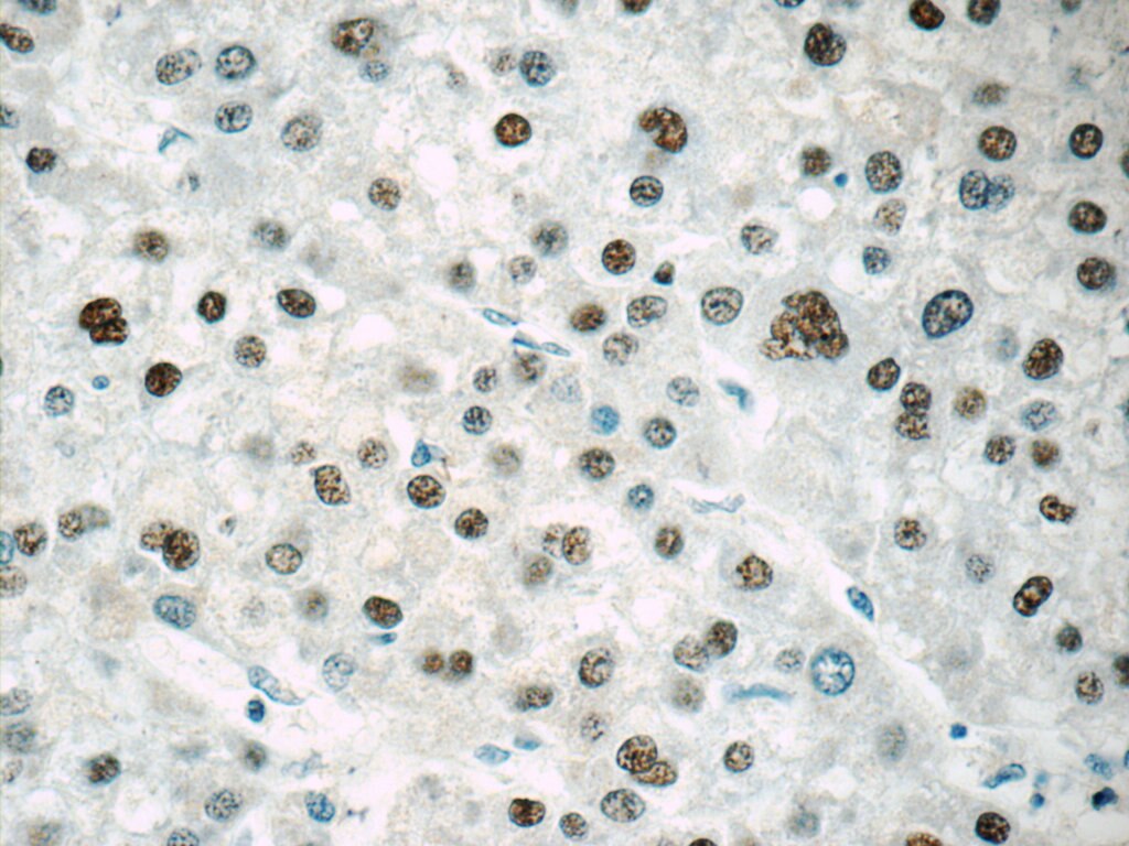 Immunohistochemistry (IHC) staining of human liver cancer tissue using ONECUT1 Polyclonal antibody (25137-1-AP)