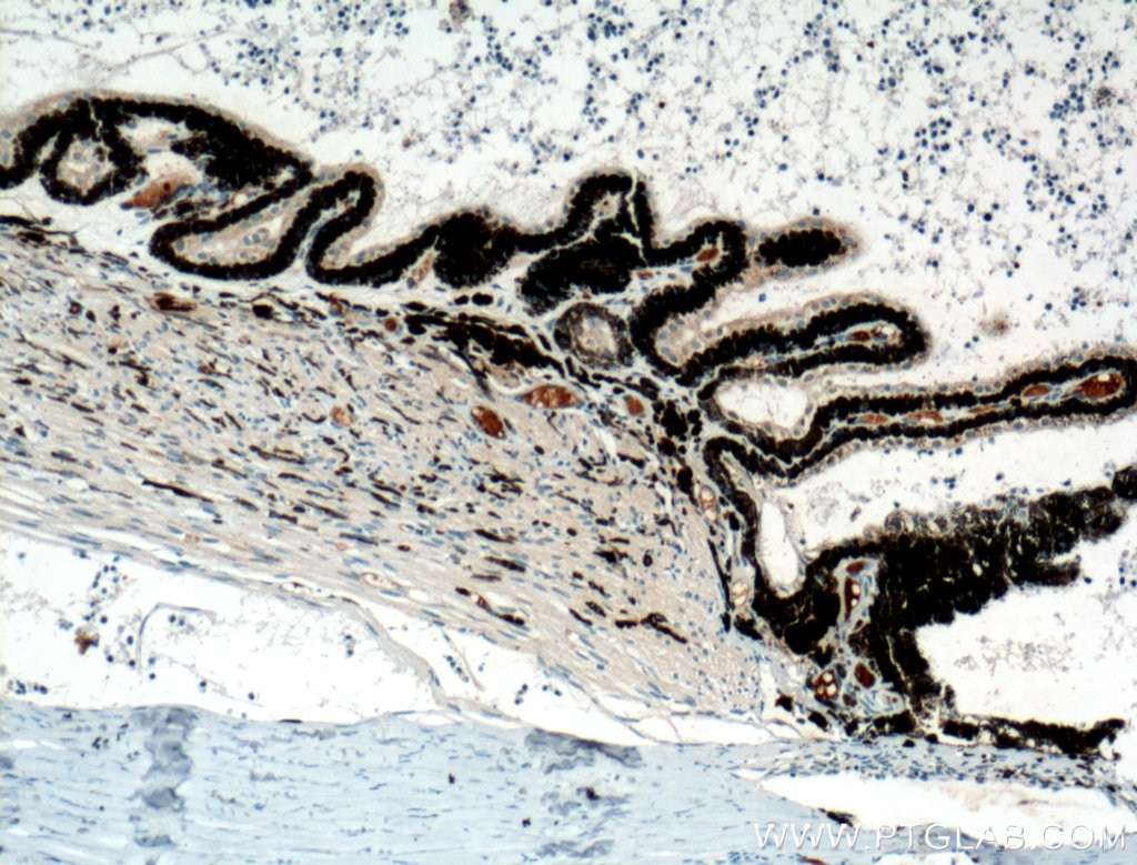 Immunohistochemistry (IHC) staining of human retinoblastoma tissue using Oligophrenin 1 Polyclonal antibody (11076-1-AP)