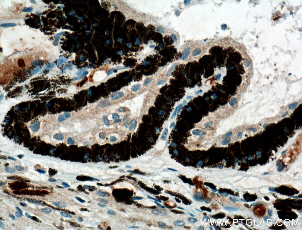 IHC staining of human retinoblastoma using 11076-1-AP