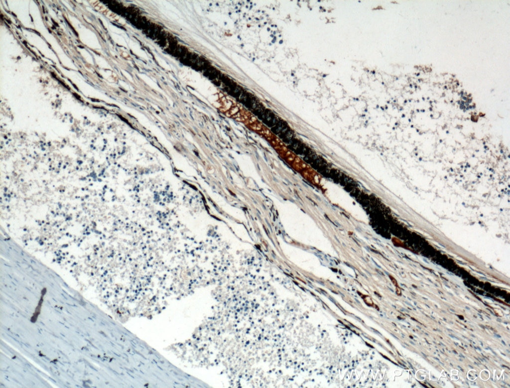 Immunohistochemistry (IHC) staining of human retinoblastoma tissue using Oligophrenin 1 Polyclonal antibody (11076-1-AP)