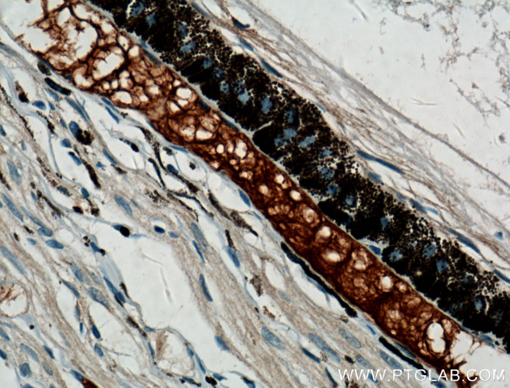 IHC staining of human retinoblastoma using 11076-1-AP