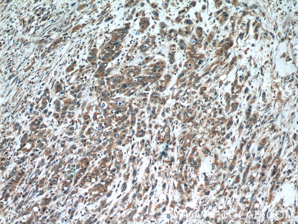 Immunohistochemistry (IHC) staining of human stomach cancer tissue using Oligophrenin 1 Polyclonal antibody (17445-1-AP)