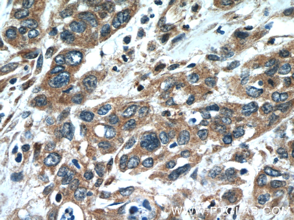 Immunohistochemistry (IHC) staining of human stomach cancer tissue using Oligophrenin 1 Polyclonal antibody (17445-1-AP)
