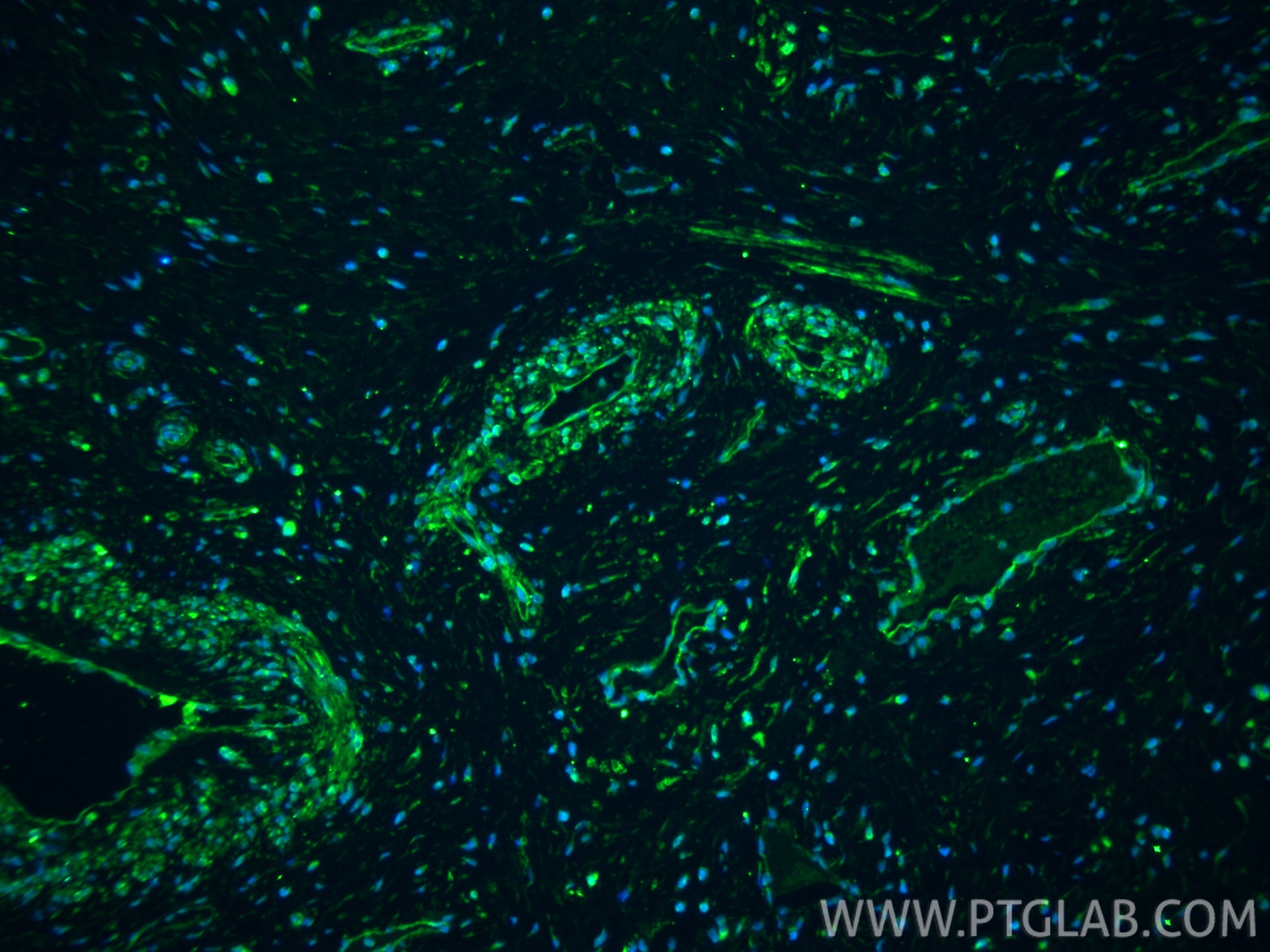IF Staining of human cervical cancer using 22952-1-AP Immunofluorescence (IF) / fluorescent staining of human cervical cancer tissue using Osteopontin Polyclonal antibody (22952-1-AP)