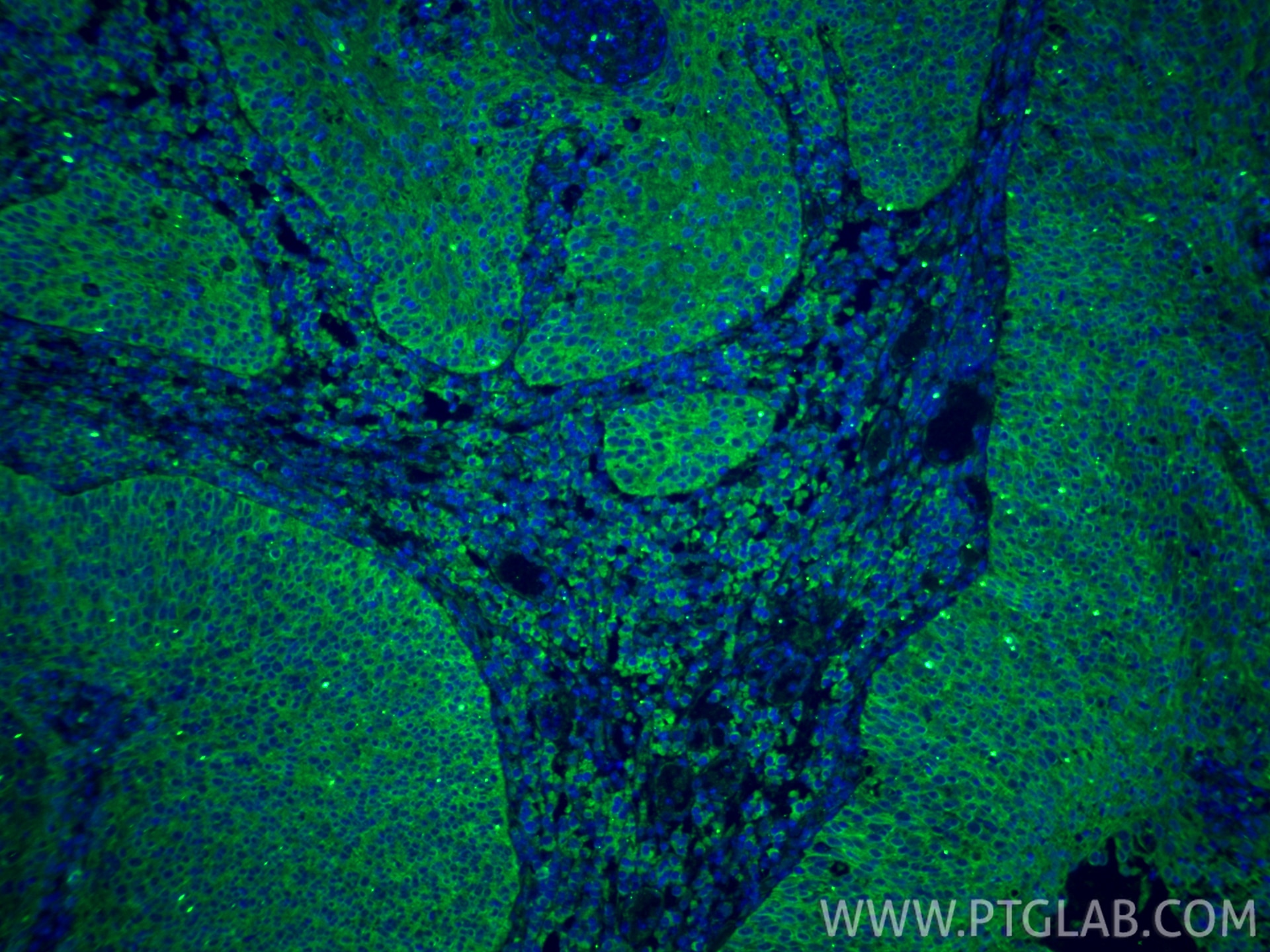 IF Staining of human cervical cancer using 22952-1-AP Immunofluorescence (IF) / fluorescent staining of human cervical cancer tissue using Osteopontin Polyclonal antibody (22952-1-AP)