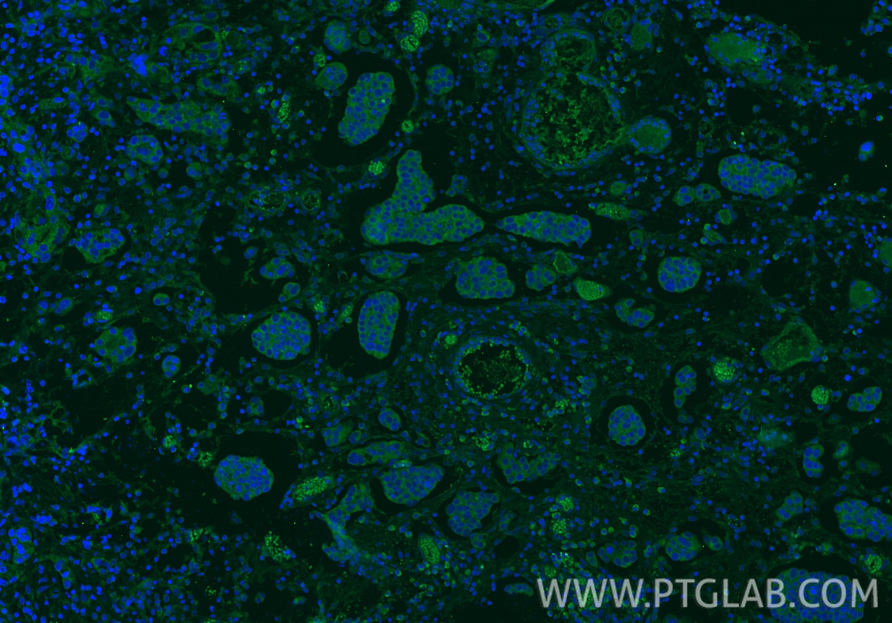 IF Staining of human ovary tumor using 22952-1-AP Immunofluorescence (IF) / fluorescent staining of human ovary tumor tissue using Osteopontin Polyclonal antibody (22952-1-AP)