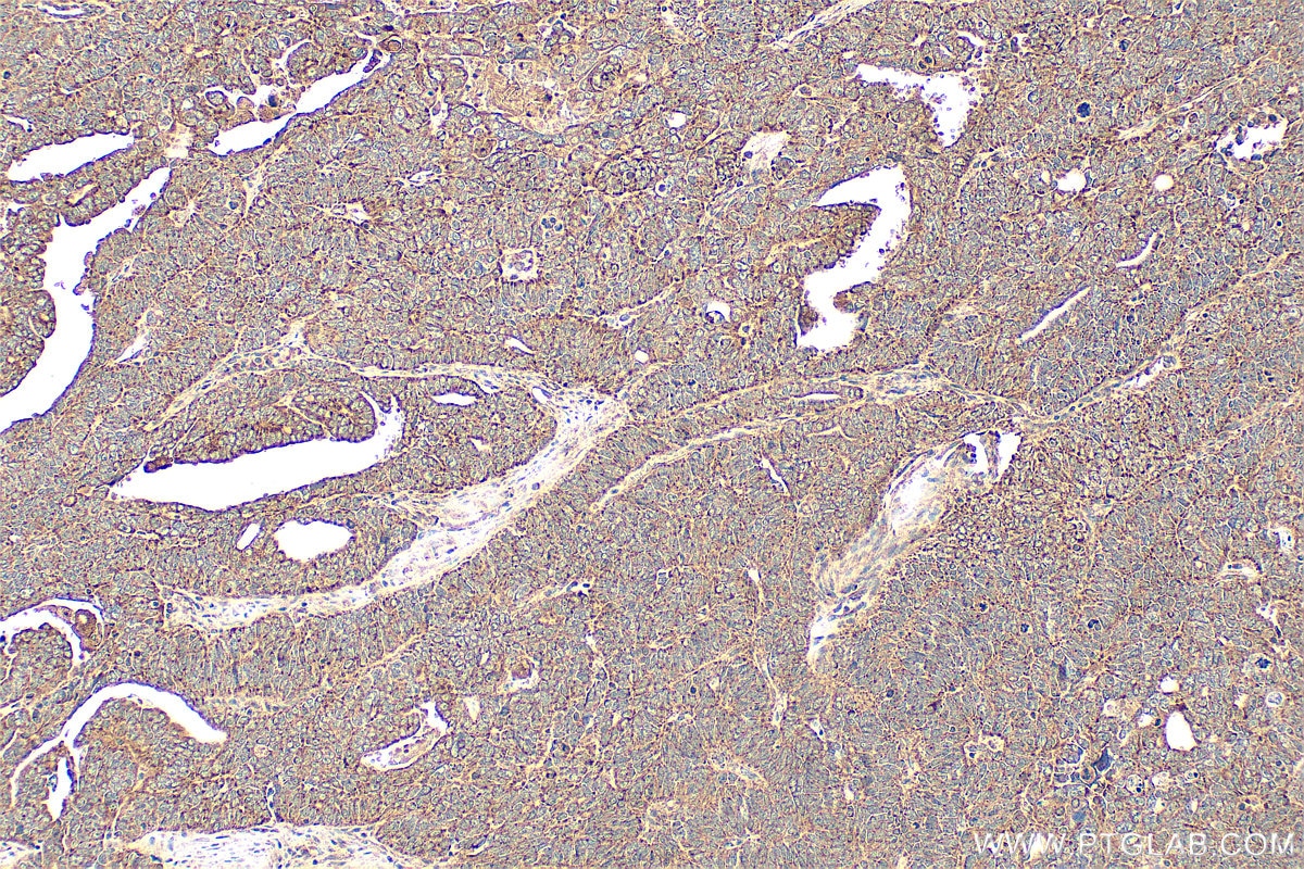 Immunohistochemistry (IHC) staining of human ovary tumor tissue using Osteopontin Polyclonal antibody (22952-1-AP)
