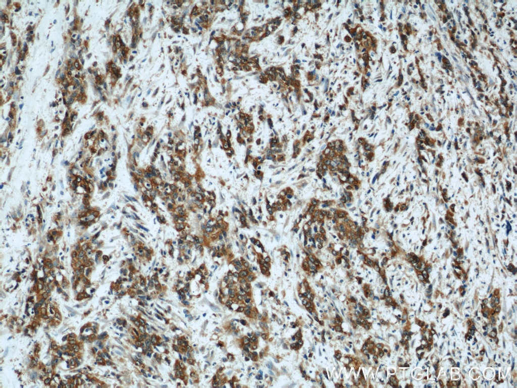 IHC staining of human stomach cancer using 22952-1-AP