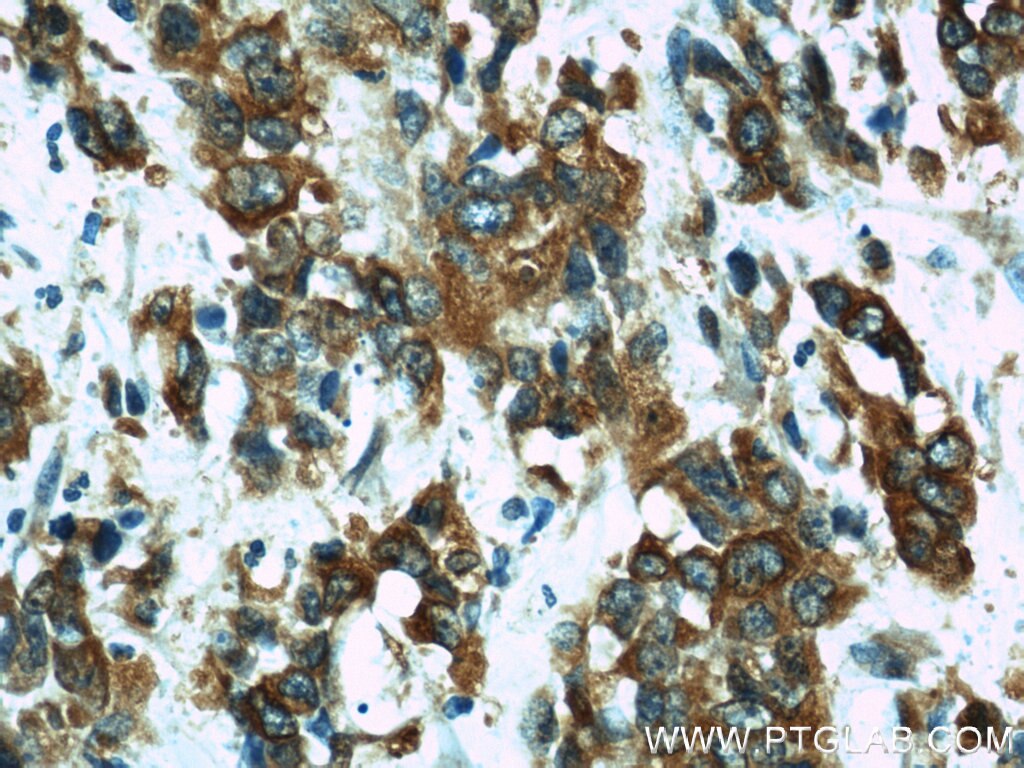 Immunohistochemistry (IHC) staining of human stomach cancer tissue using Osteopontin Polyclonal antibody (22952-1-AP)