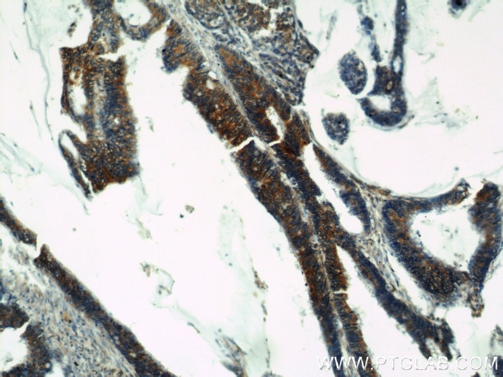 Immunohistochemistry (IHC) staining of human colon cancer tissue using Osteopontin Polyclonal antibody (22952-1-AP)