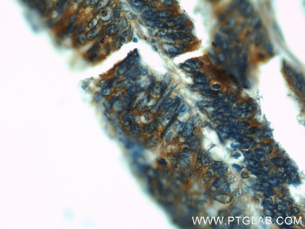 Immunohistochemistry (IHC) staining of human colon cancer tissue using Osteopontin Polyclonal antibody (22952-1-AP)