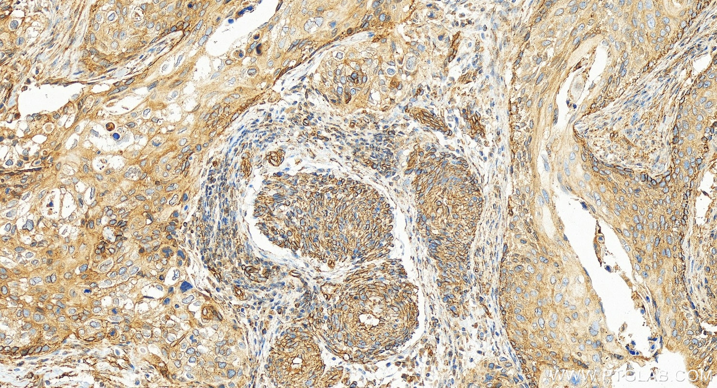 Immunohistochemistry (IHC) staining of human cervical squamous cancer tissue using Osteopontin Recombinant monoclonal antibody (83341-1-RR)