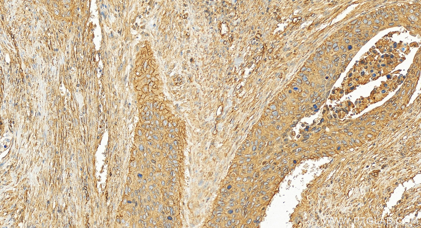 Immunohistochemistry (IHC) staining of human cervical squamous cancer tissue using Osteopontin Recombinant monoclonal antibody (83341-1-RR)