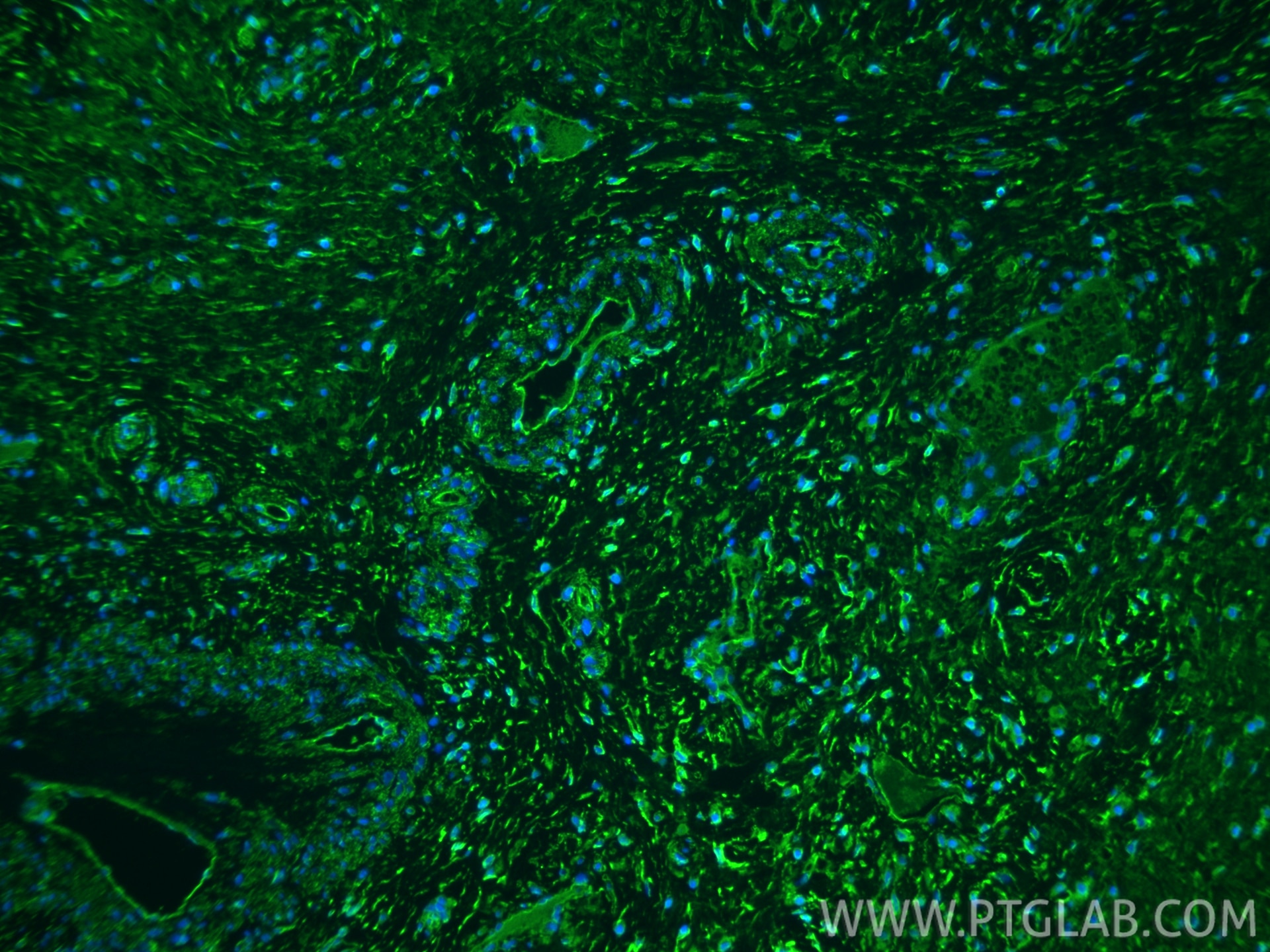 Immunofluorescence (IF) / fluorescent staining of human cervical cancer tissue using Osteopontin Recombinant monoclonal antibody (83341-1-RR)