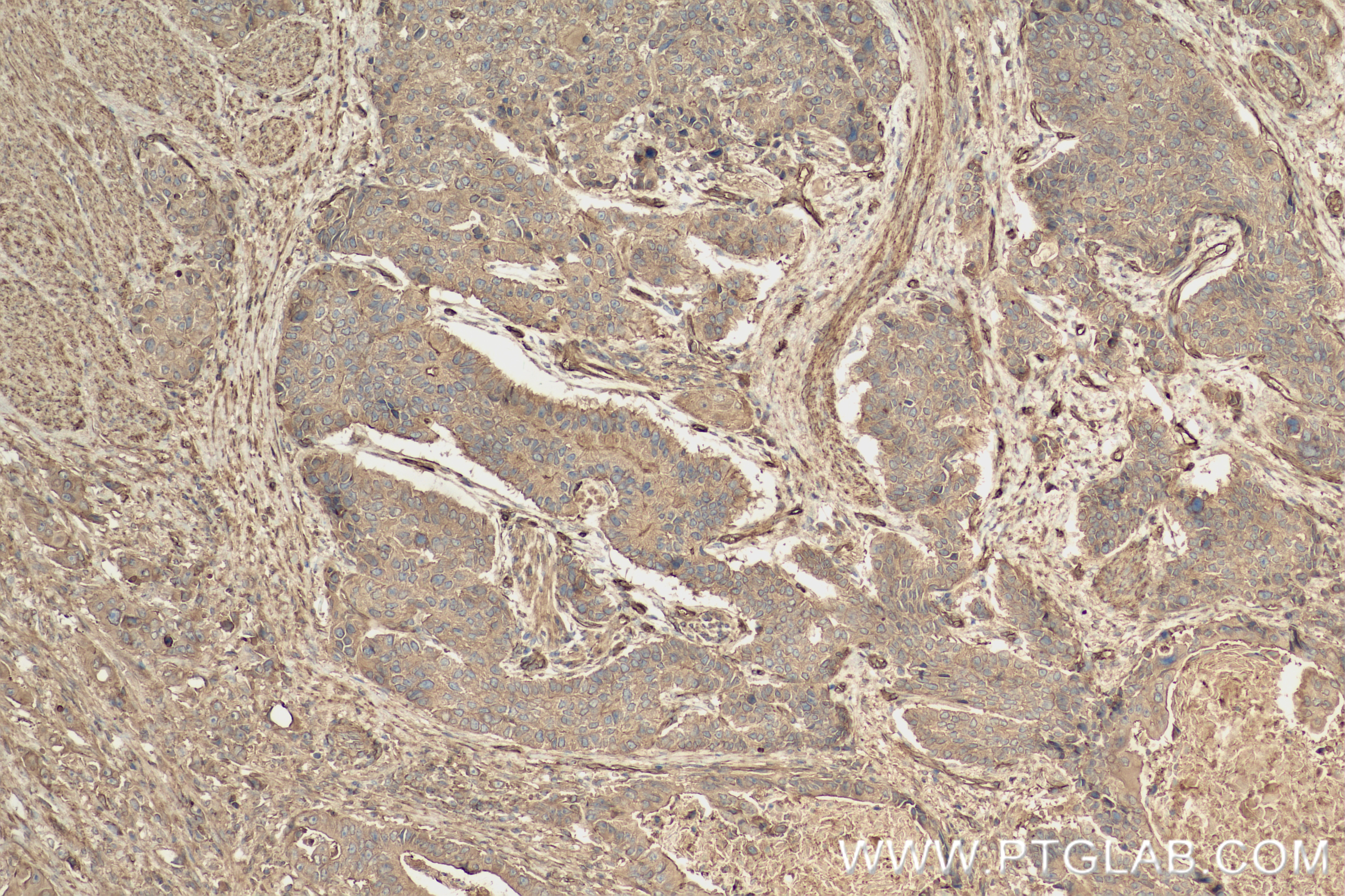 Immunohistochemistry (IHC) staining of human stomach cancer tissue using Osteopontin Recombinant monoclonal antibody (83341-1-RR)