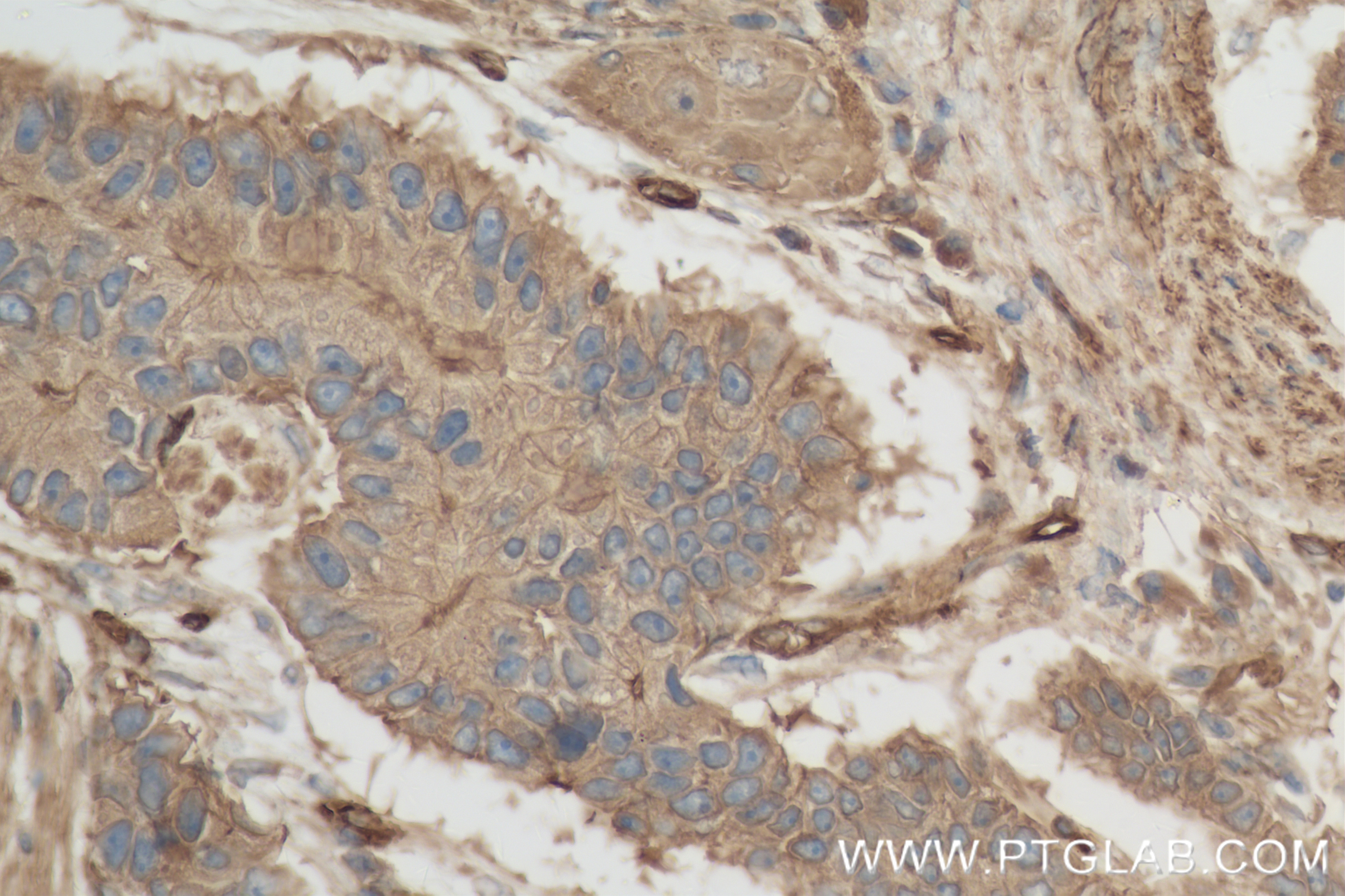 Immunohistochemistry (IHC) staining of human stomach cancer tissue using Osteopontin Recombinant monoclonal antibody (83341-1-RR)
