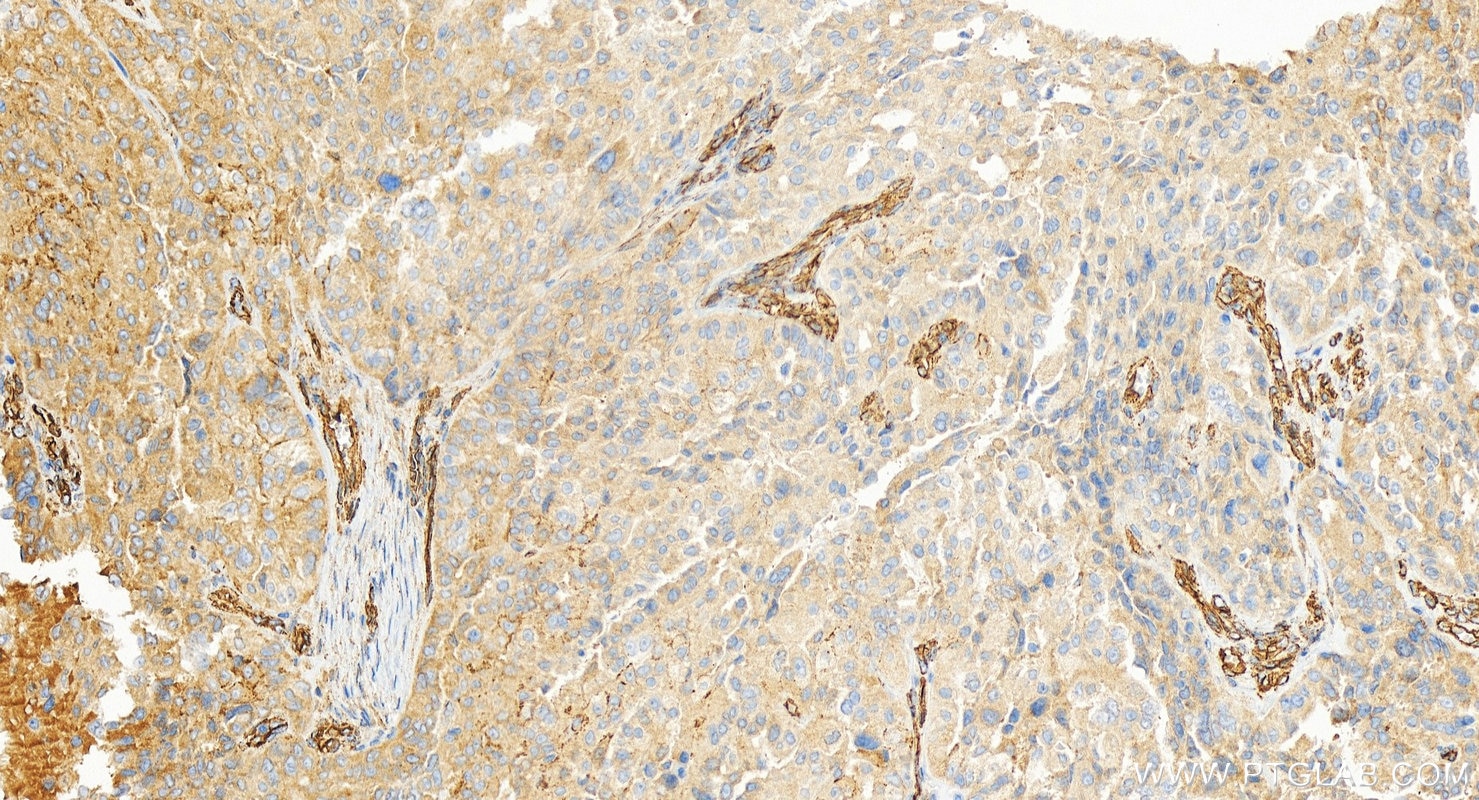 Immunohistochemistry (IHC) staining of human ovary cancer tissue using Osteopontin Recombinant monoclonal antibody (83341-1-RR)