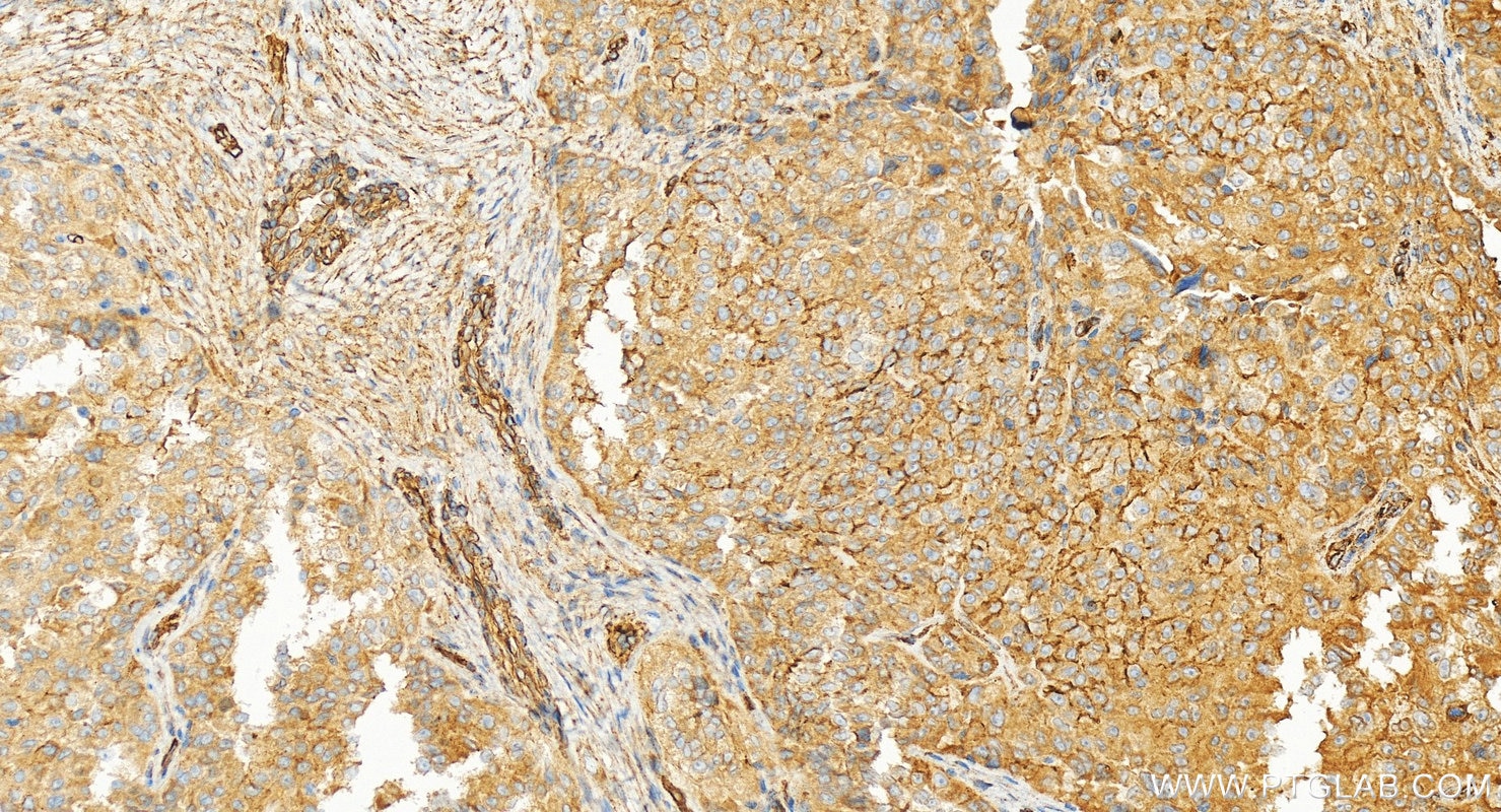 Immunohistochemistry (IHC) staining of human ovary cancer tissue using Osteopontin Recombinant monoclonal antibody (83341-1-RR)