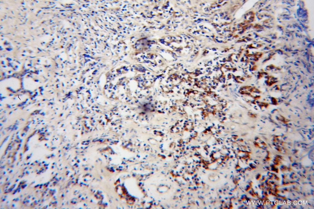 Immunohistochemistry (IHC) staining of human gliomas tissue using OPRL1 Polyclonal antibody (12970-1-AP)