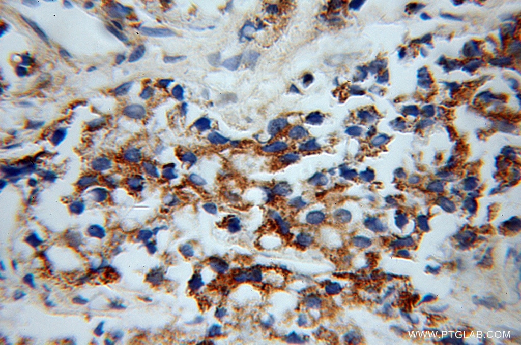 Immunohistochemistry (IHC) staining of human gliomas tissue using OPRL1 Polyclonal antibody (12970-1-AP)