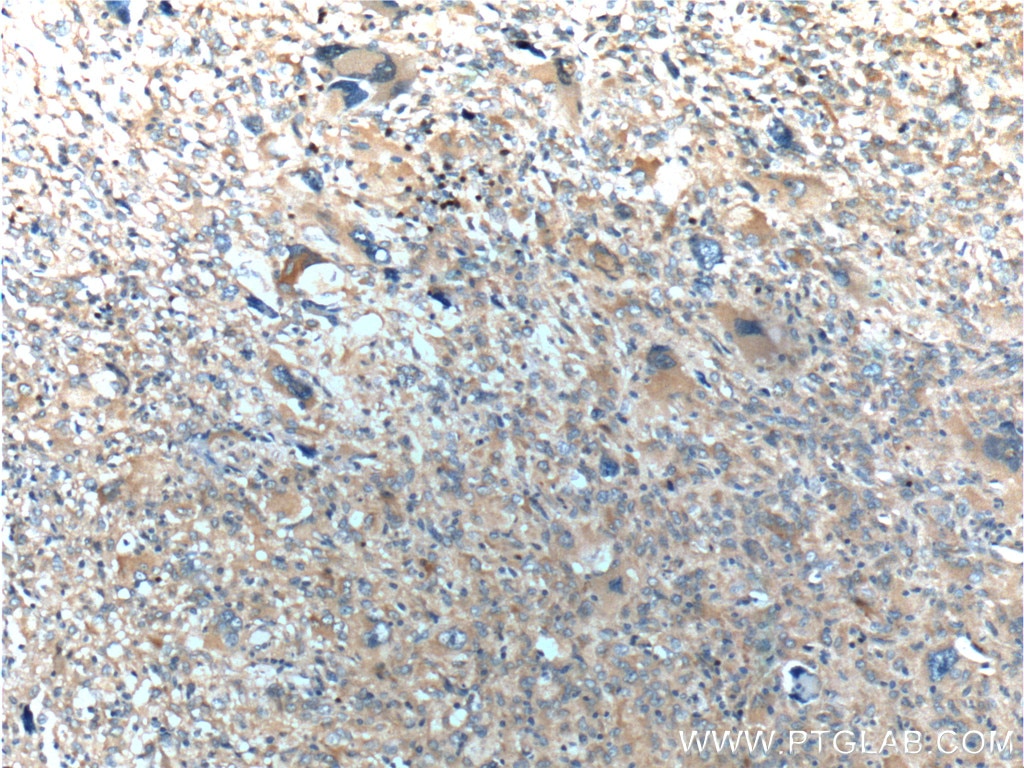 Immunohistochemistry (IHC) staining of human gliomas tissue using OPTN Polyclonal antibody (10837-1-AP)