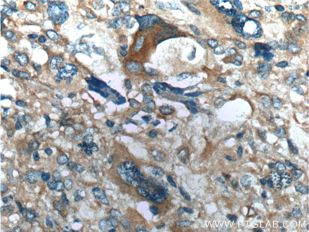 Immunohistochemistry (IHC) staining of human gliomas tissue using OPTN Polyclonal antibody (10837-1-AP)