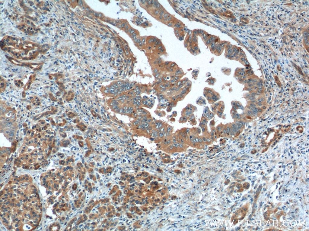 Immunohistochemistry (IHC) staining of human pancreas cancer tissue using OPTN Monoclonal antibody (60293-1-Ig)