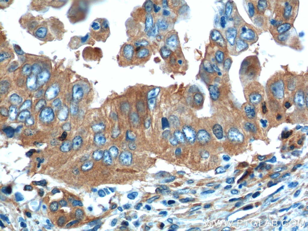 IHC staining of human pancreas cancer using 60293-1-Ig