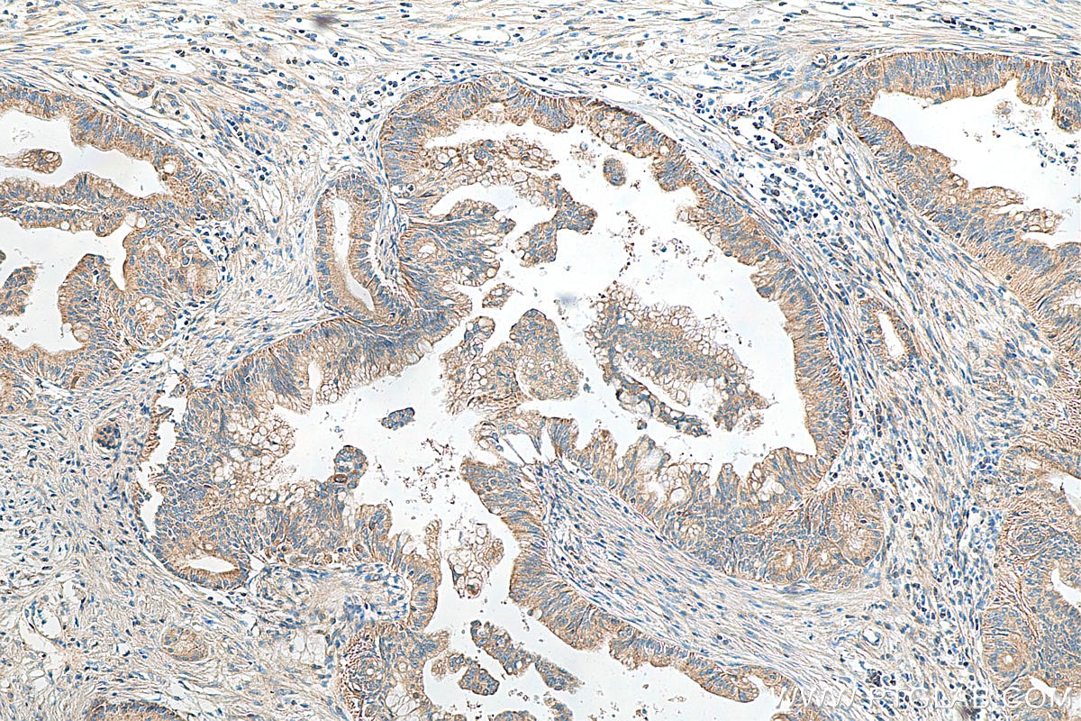 Immunohistochemistry (IHC) staining of human pancreas cancer tissue using Biotin-conjugated OPTN Monoclonal antibody (Biotin-60293)