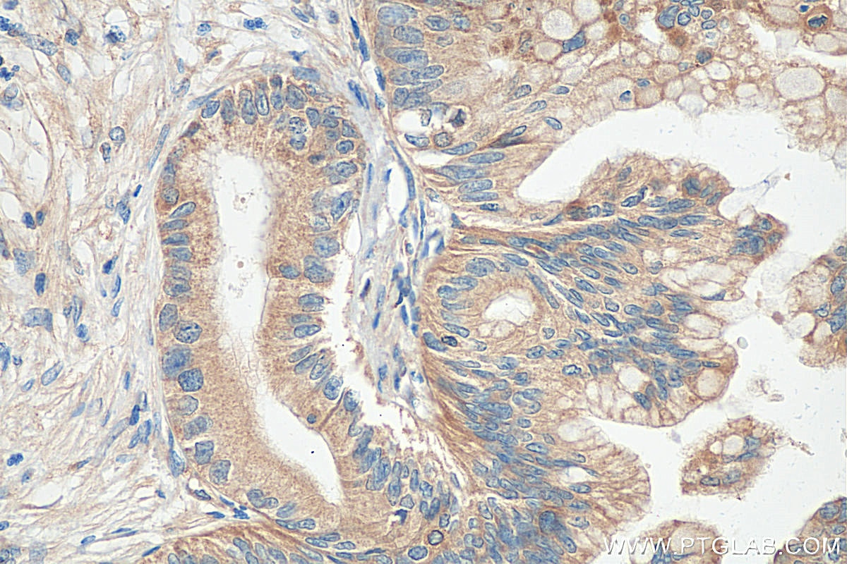 Immunohistochemistry (IHC) staining of human pancreas cancer tissue using Biotin-conjugated Optineurin Monoclonal antibody (Biotin-60293)