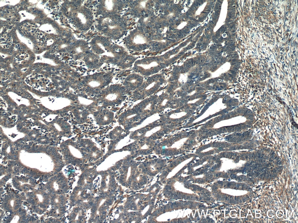 Immunohistochemistry (IHC) staining of human endometrial cancer tissue using ORAI3 Polyclonal antibody (25766-1-AP)