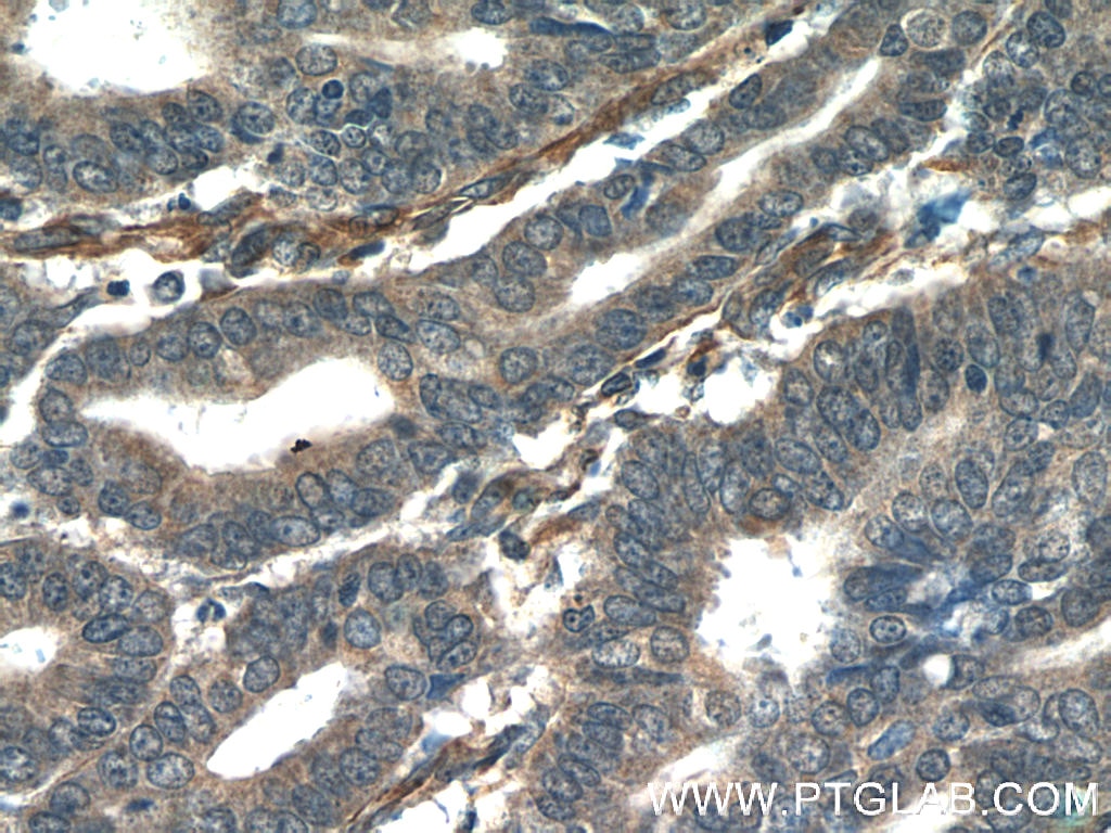 Immunohistochemistry (IHC) staining of human endometrial cancer tissue using ORAI3 Polyclonal antibody (25766-1-AP)