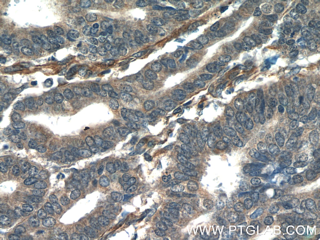 IHC staining of human endometrial cancer using 25766-1-AP