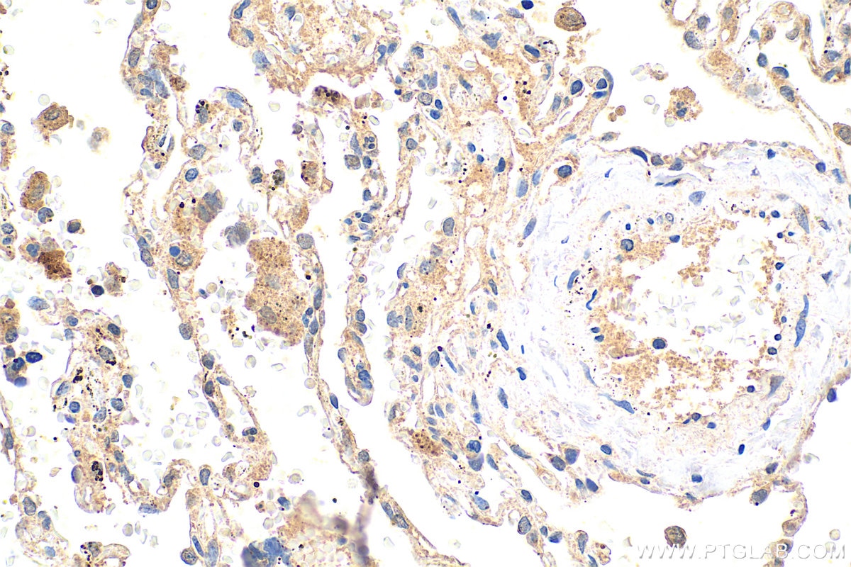 Immunohistochemistry (IHC) staining of human lung cancer tissue using ORAI3 Polyclonal antibody (25766-1-AP)