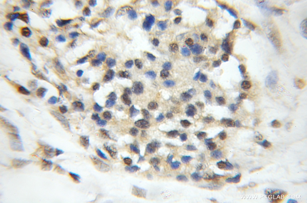 Immunohistochemistry (IHC) staining of human pancreas cancer tissue using ORC5L Polyclonal antibody (11542-1-AP)