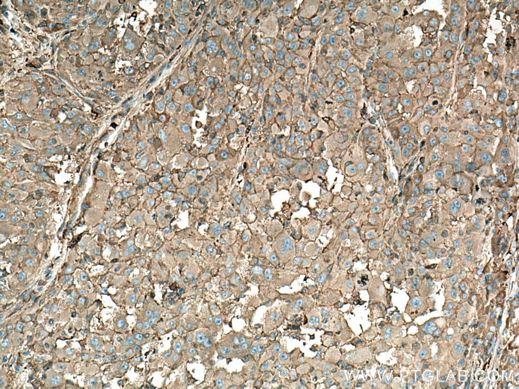 Immunohistochemistry (IHC) staining of human liver cancer tissue using ORM1 Polyclonal antibody (16439-1-AP)