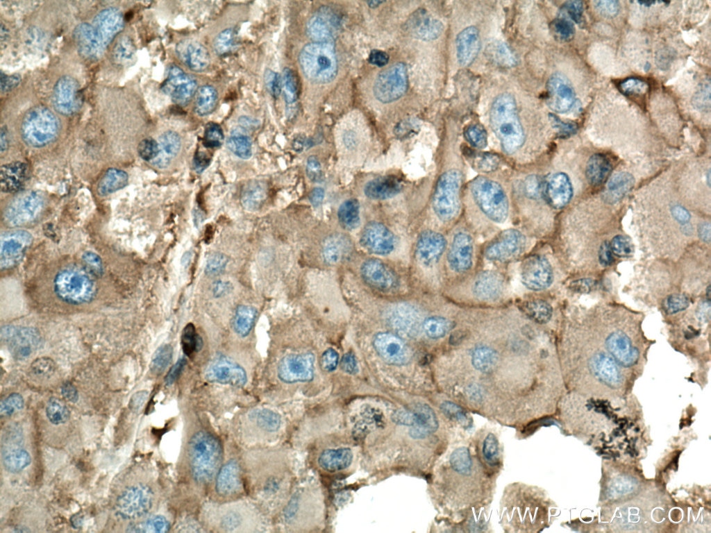 Immunohistochemistry (IHC) staining of human liver cancer tissue using ORM1 Polyclonal antibody (16439-1-AP)