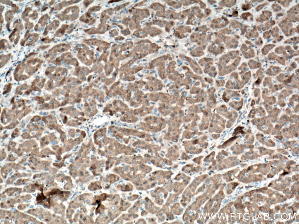 Immunohistochemistry (IHC) staining of human liver cancer tissue using ORM1/2 Monoclonal antibody (66097-1-Ig)