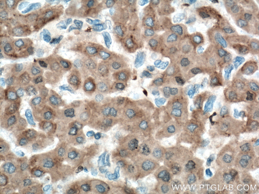 Immunohistochemistry (IHC) staining of human liver cancer tissue using ORM1/2 Monoclonal antibody (66097-1-Ig)