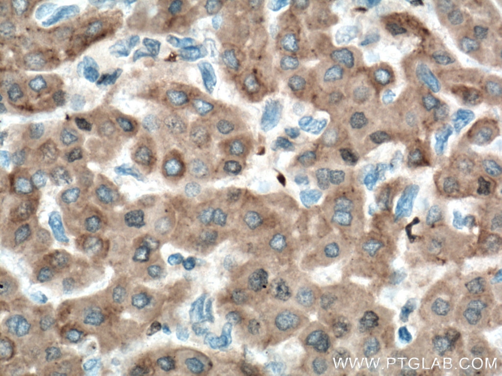 Immunohistochemistry (IHC) staining of human liver cancer tissue using ORM1/2 Monoclonal antibody (66097-1-Ig)