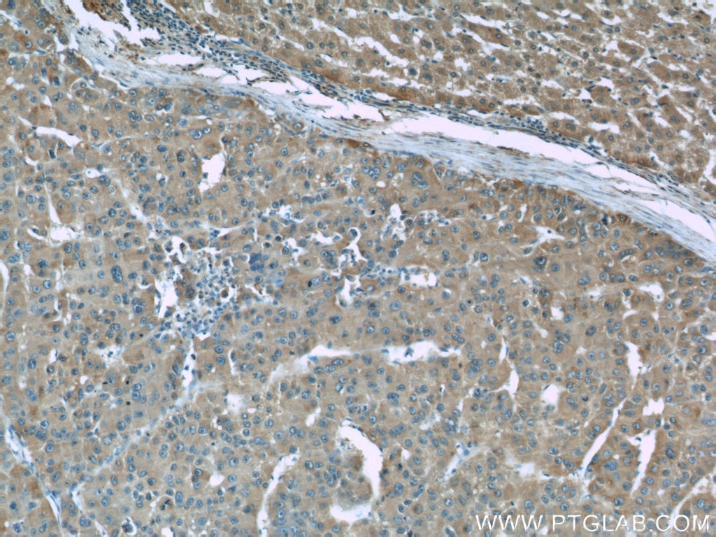 Immunohistochemistry (IHC) staining of human liver cancer tissue using ORM1/2 Monoclonal antibody (66097-1-Ig)