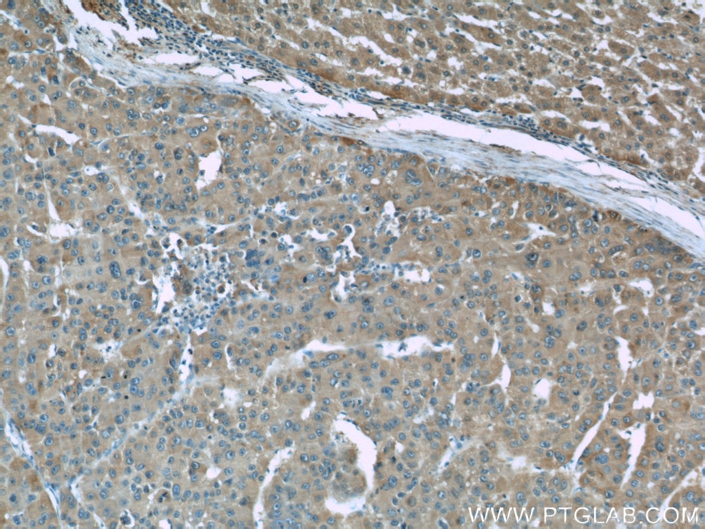 IHC staining of human liver cancer using 66097-1-Ig