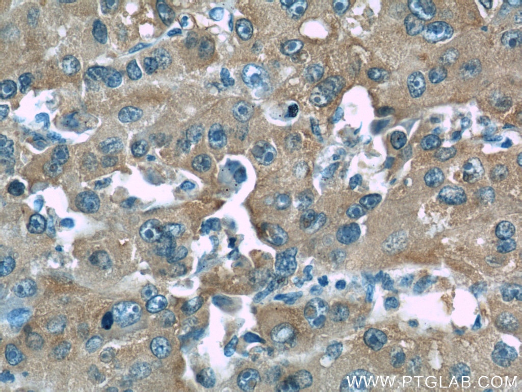 Immunohistochemistry (IHC) staining of human liver cancer tissue using ORM1/2 Monoclonal antibody (66097-1-Ig)