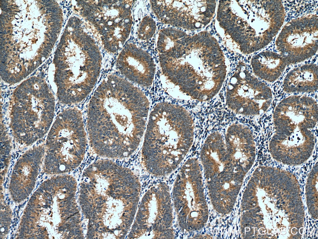 Immunohistochemistry (IHC) staining of human colon cancer tissue using ORM2-Specific Monoclonal antibody (66217-1-Ig)
