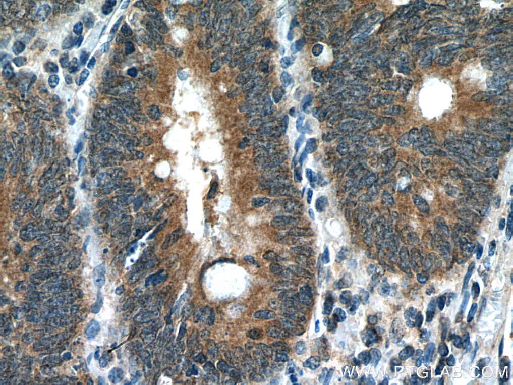 Immunohistochemistry (IHC) staining of human colon cancer tissue using ORM2-Specific Monoclonal antibody (66217-1-Ig)