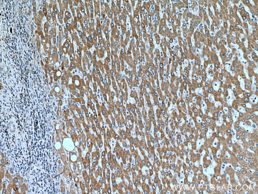 Immunohistochemistry (IHC) staining of human liver cancer tissue using ORM2-Specific Monoclonal antibody (66217-1-Ig)