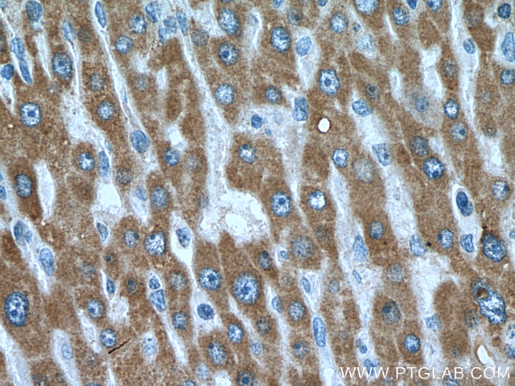 Immunohistochemistry (IHC) staining of human liver cancer tissue using ORM2-Specific Monoclonal antibody (66217-1-Ig)