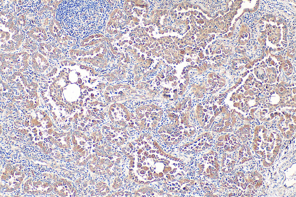 Immunohistochemistry (IHC) staining of human lung cancer tissue using OS9 Polyclonal antibody (10061-1-AP)
