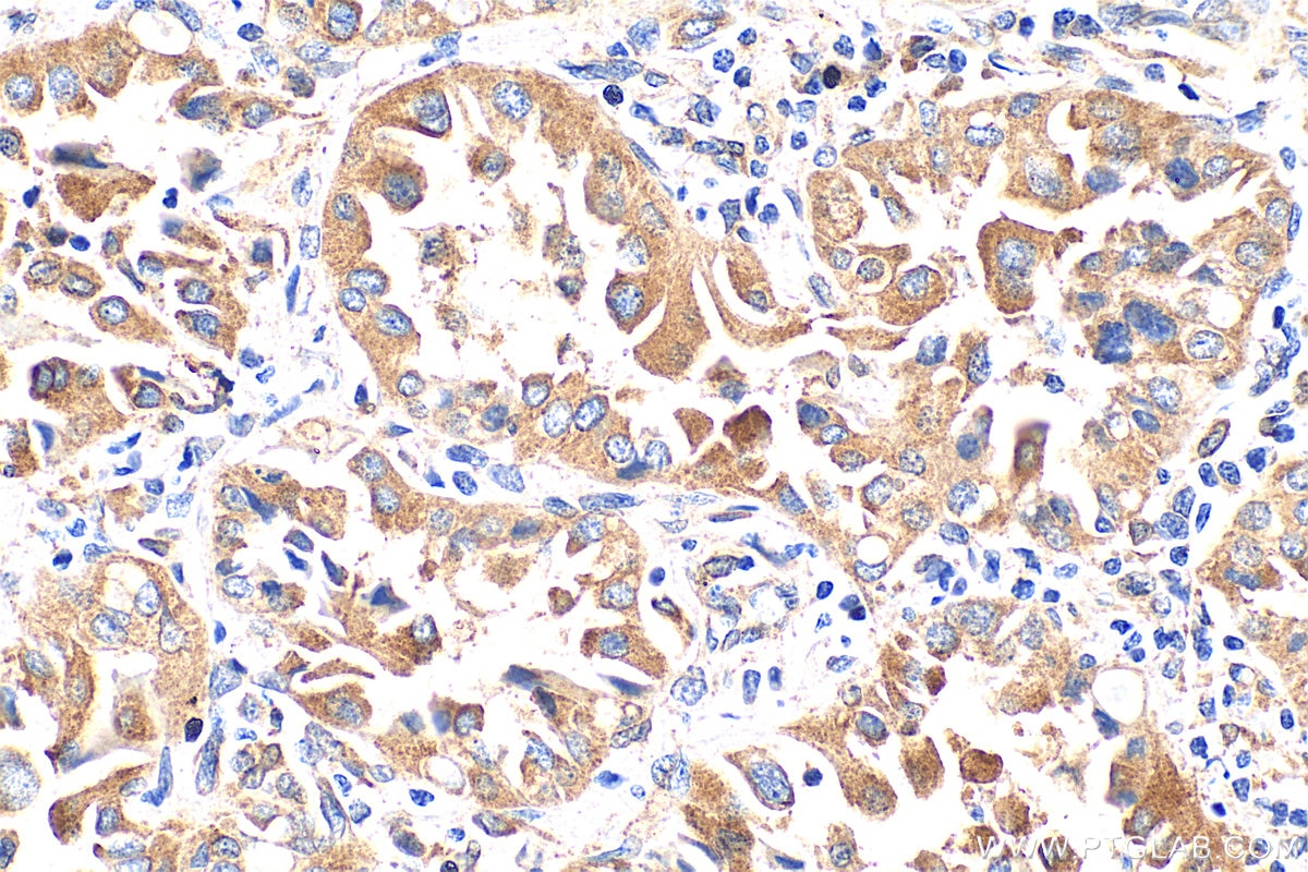Immunohistochemistry (IHC) staining of human lung cancer tissue using OS9 Polyclonal antibody (10061-1-AP)